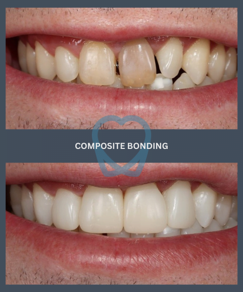 Before and after 1