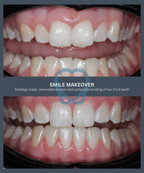Before and after 11