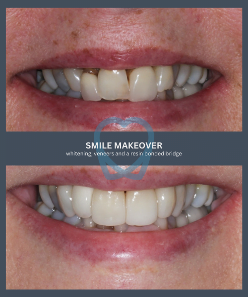 Before and after 3