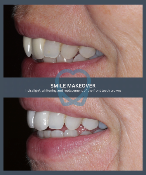 Before and after 4