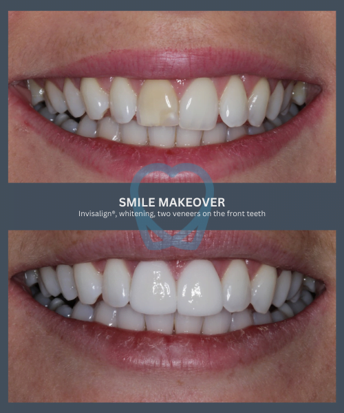 Before and after 9